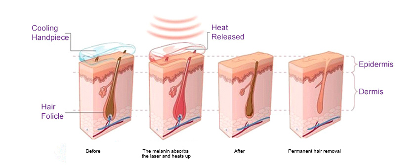 Wie Wahlt Man Eine Zuverlassige Diodenlaser Haarentfernungsmaschine Vom Lieferanten Aus China Leaflife Technology Manufacturers Of Medical Aesthetic Laser Equipment
